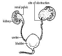 PELVI URETRIC JUNCTION OBSTRUCTION