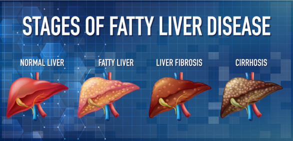 The Different Fatty Liver Disease Stages